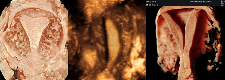role-of-doppler-and-4d-ultrasound-in-infertility-and-gyneacology